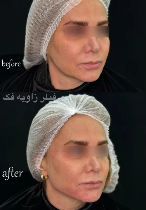 نمونه کار تزریق فیلر زاویه فک دکتر علیرضا خیرالهی