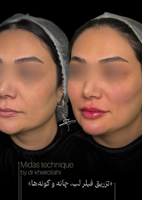 filler injection portfolio (1)