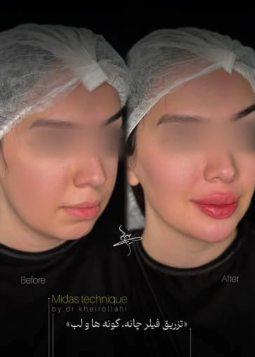 filler injection portfolio (3)