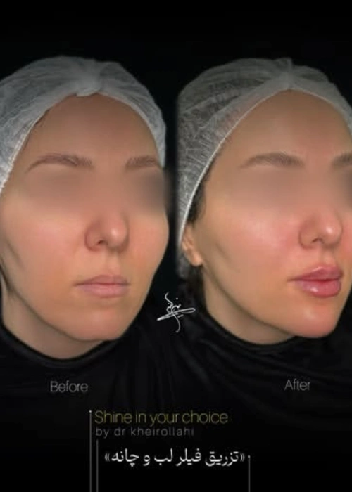 filler injection portfolio (4)