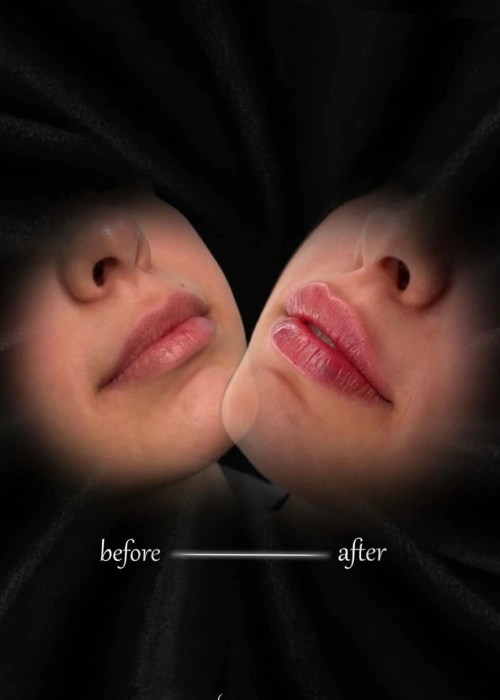filler injection portfolio (6)