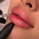 تزریق ژل لب روسی برای خانمی که در کلینیک روی تخت دراز کشیده است.