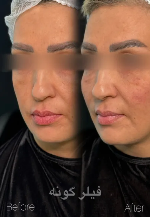 نمونه کار تزریق فیلر گونه دکتر علیرضا خیرالهی
