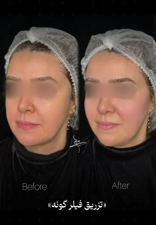 نمونه کار تزریق فیلر گونه دکتر علیرضا خیرالهی