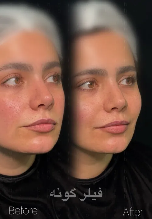 نمونه کار تزریق فیلر گونه دکتر علیرضا خیرالهی