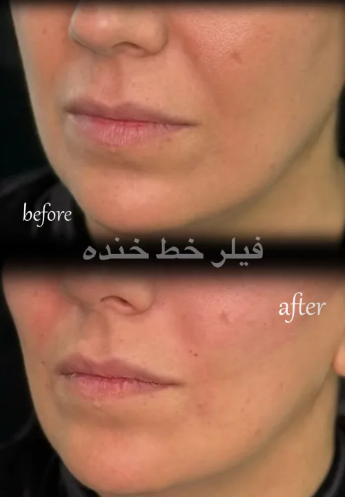 نمونه کار تزریق فیلر خط خنده دکتر علیرضا خیرالهی