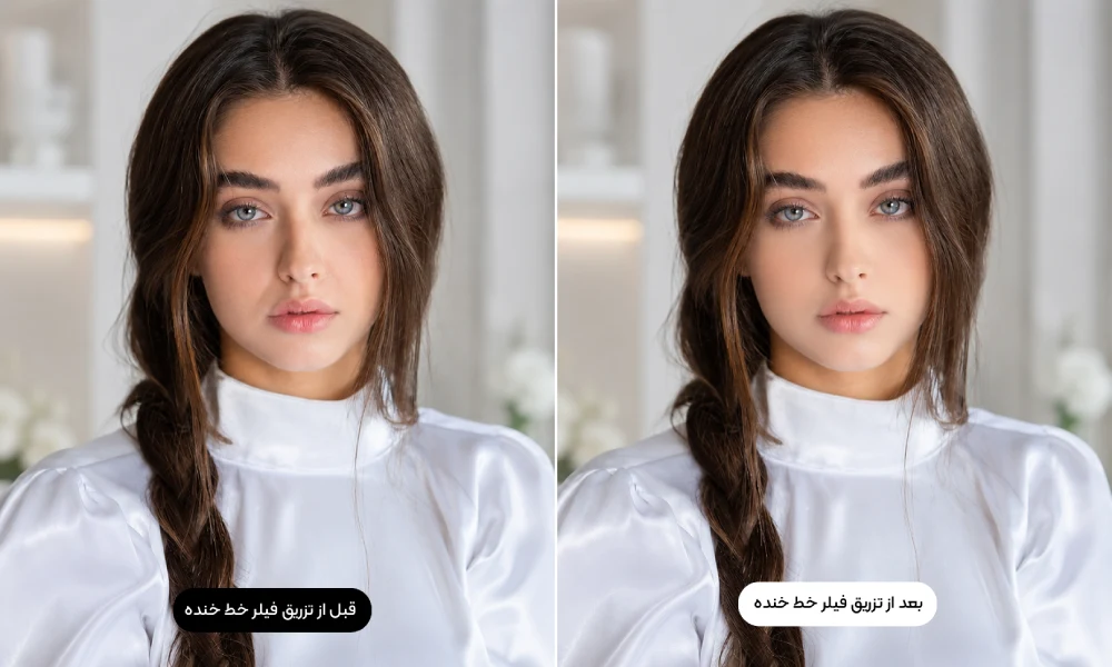 قبل و بعد از تزریق فیلر خط خنده و تغییر فرم صورت