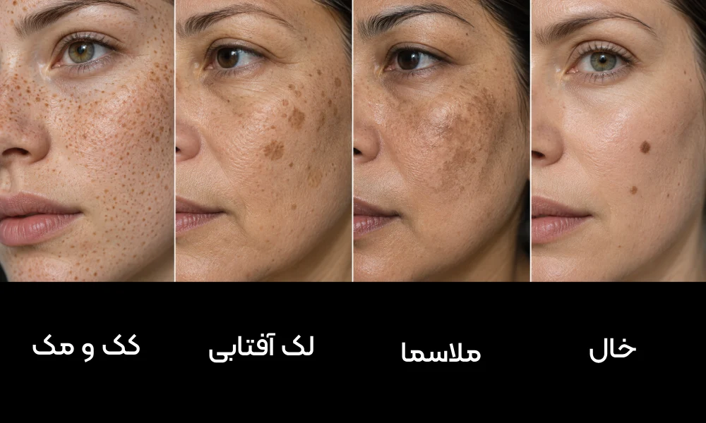 کک‌ومک، لک‌های ناشی از آفتاب، ملاسما و خال‌ها