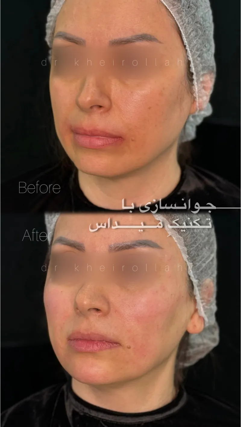 نمونه‌کار قبل و بعد تکنیک میداس