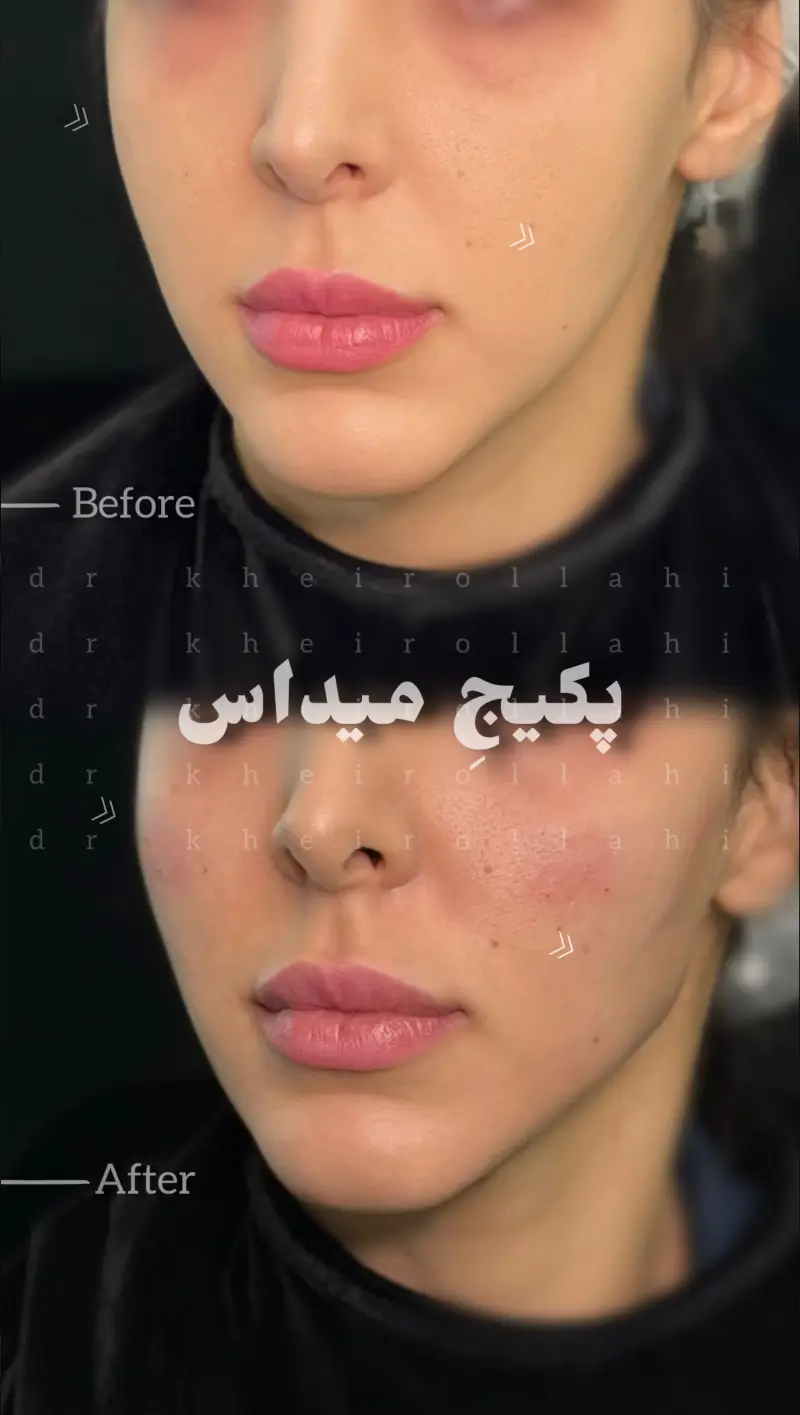 نمونه‌کار قبل و بعد تکنیک میداس