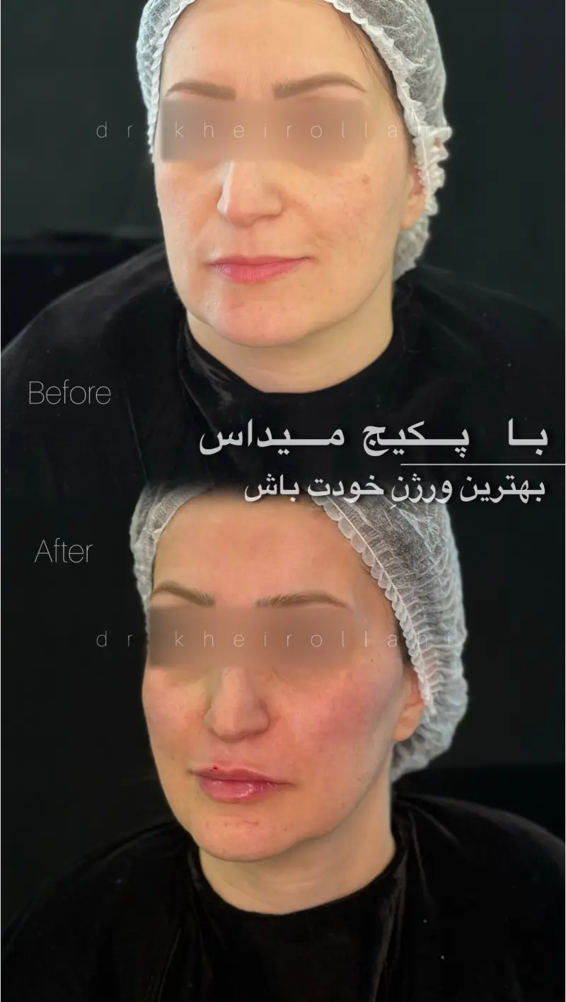 نمونه‌کار قبل و بعد تکنیک میداس