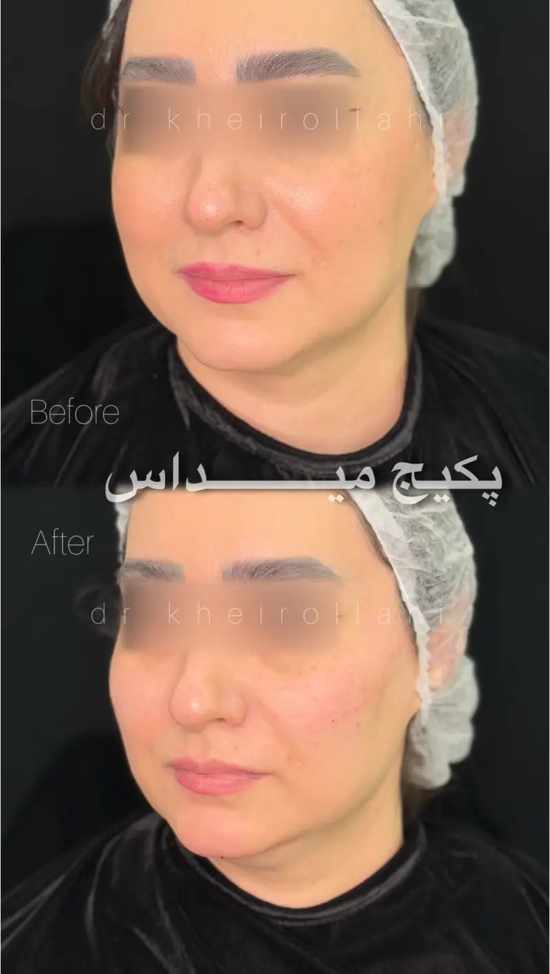 نمونه‌کار قبل و بعد تکنیک میداس
