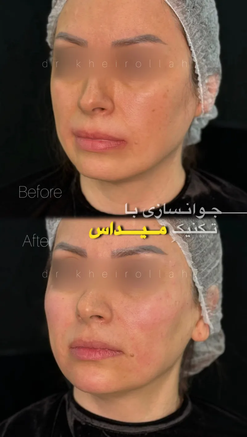نمونه‌کار قبل و بعد تکنیک میداس