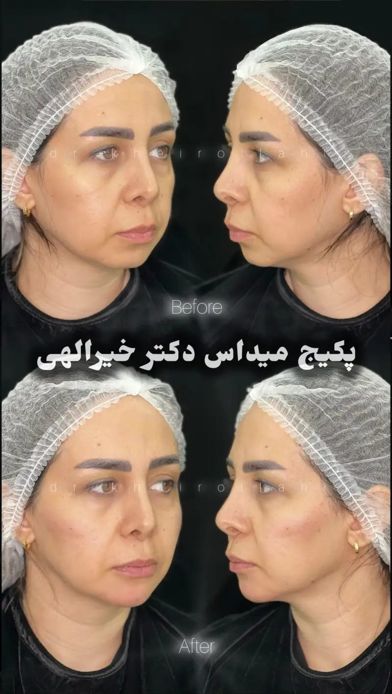 نمونه‌کار قبل و بعد تکنیک میداس