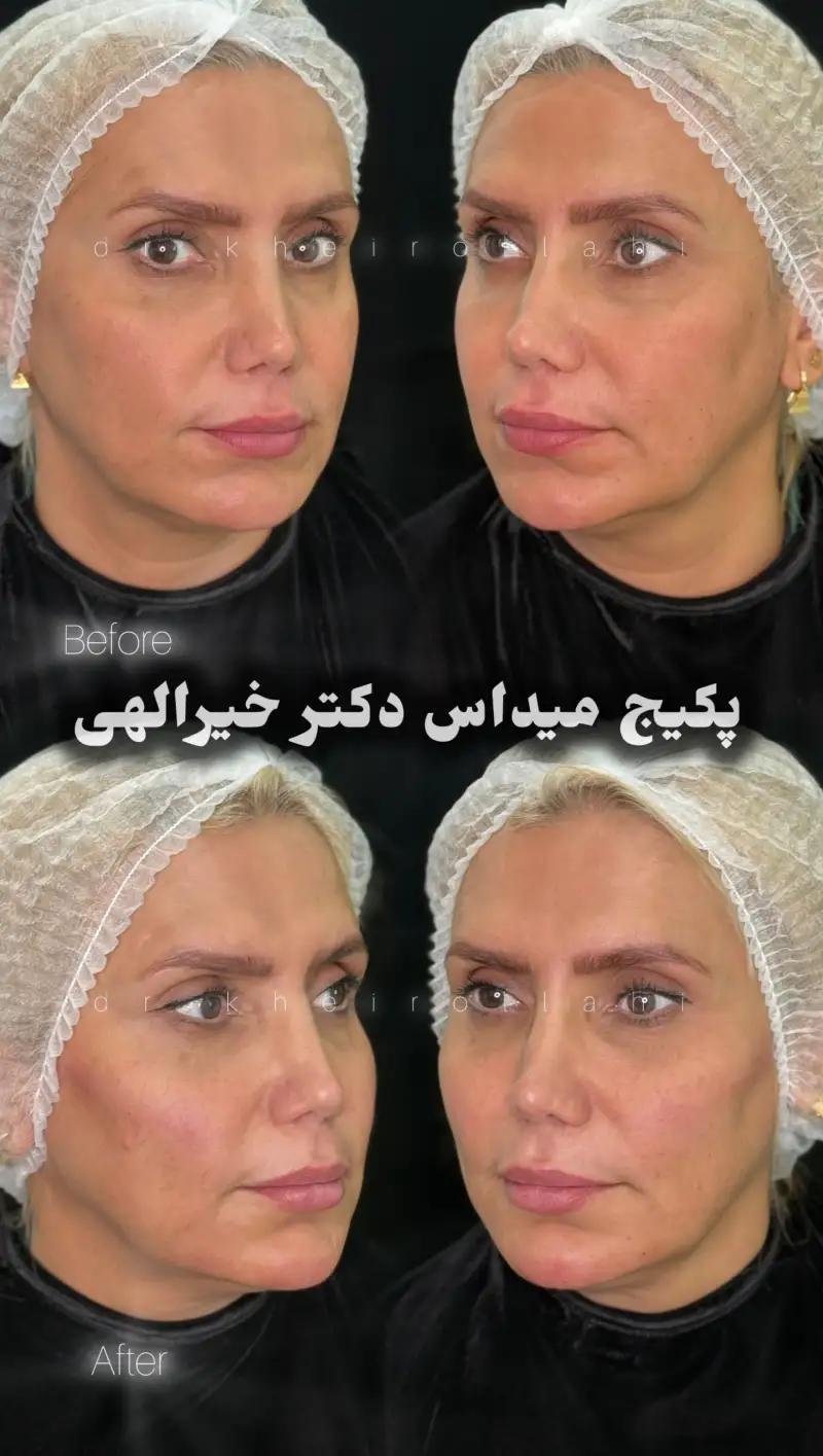 نمونه‌کار قبل و بعد تکنیک میداس