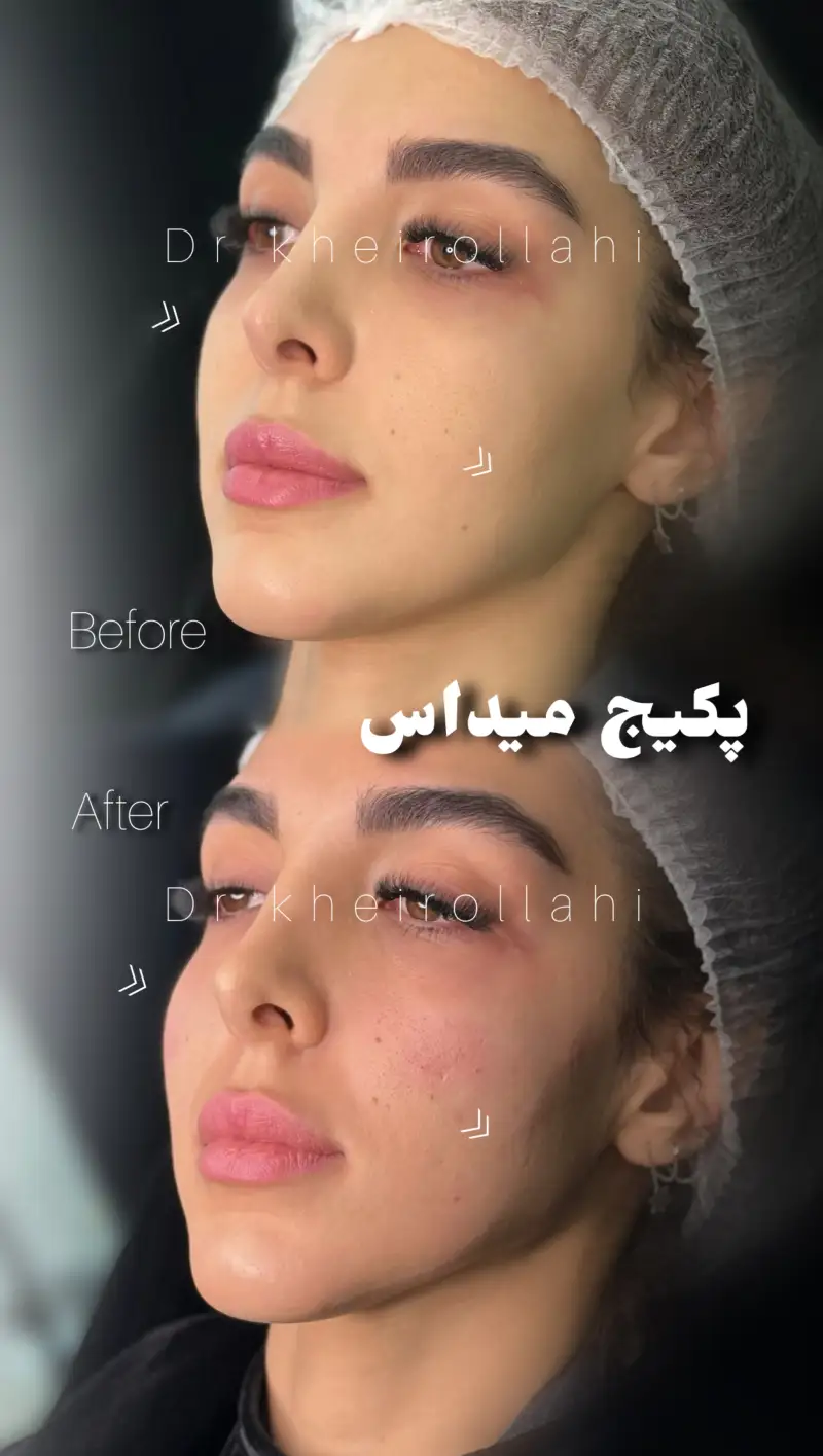 نمونه‌کار قبل و بعد تکنیک میداس