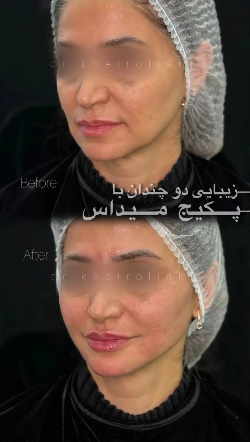 نمونه‌کار قبل و بعد تکنیک میداس