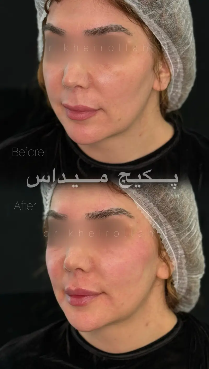 نمونه‌کار قبل و بعد تکنیک میداس