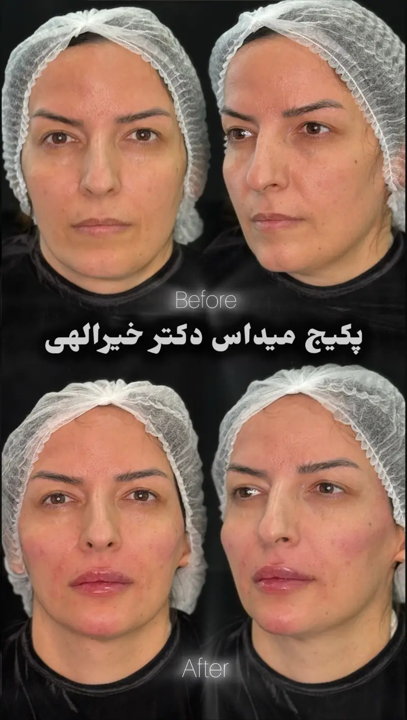 نمونه‌کار قبل و بعد تکنیک میداس