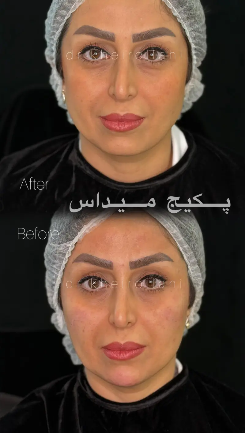 نمونه‌کار قبل و بعد تکنیک میداس