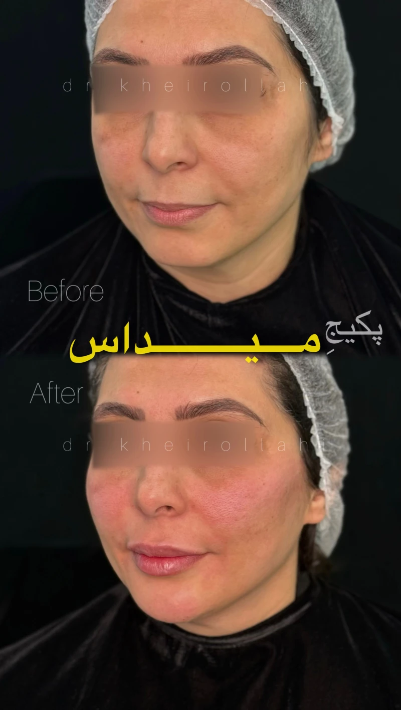 نمونه‌کار قبل و بعد تکنیک میداس