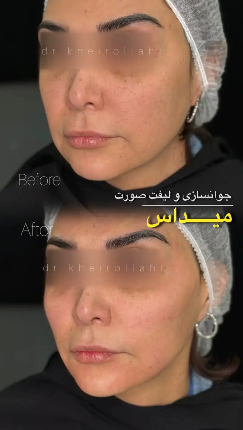 نمونه‌کار قبل و بعد تکنیک میداس