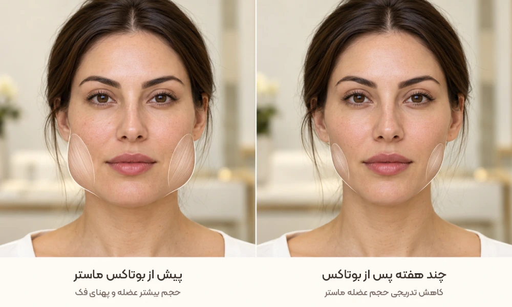اینفوگراف کاهش حجم عضله پس از بوتاکس ماستر