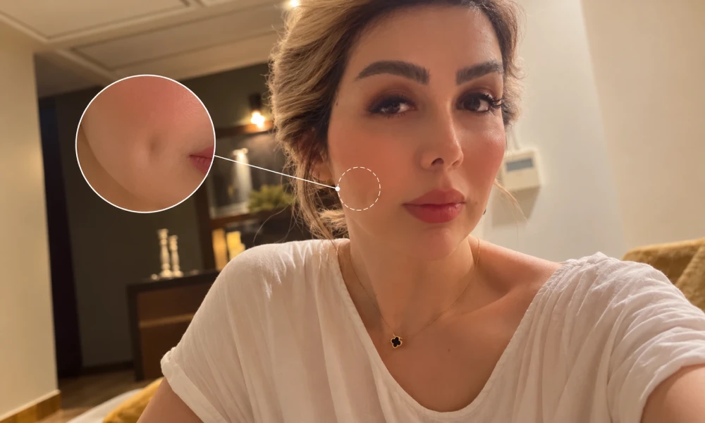 مشخص کردن نقطه ایجاد چال گونه روی صورت خانمی