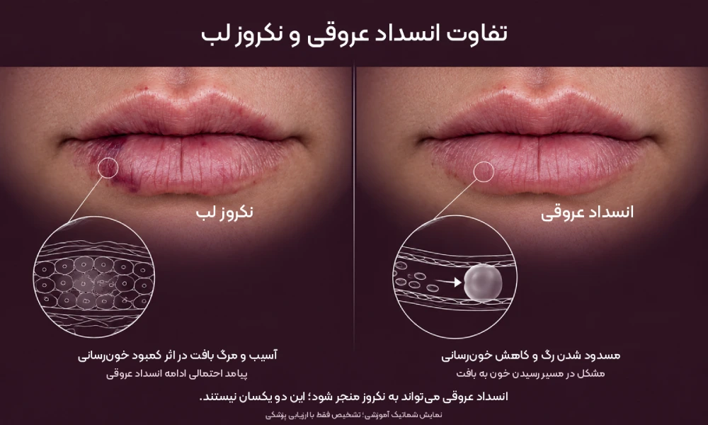 تفاوت انسداد عروقی و نکروز لب